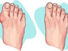 How to Reduce Bunion Size Using Natural Remedies Bunions